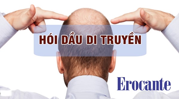 Hói dầu di truyền