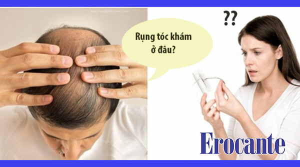 Khám rụng tóc ở bệnh viện nào