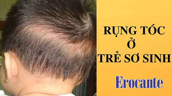 Trẻ sơ sinh bị rụng tóc nhiều