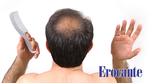 Hói đầu là nỗi ám ảnh của cánh mày râu