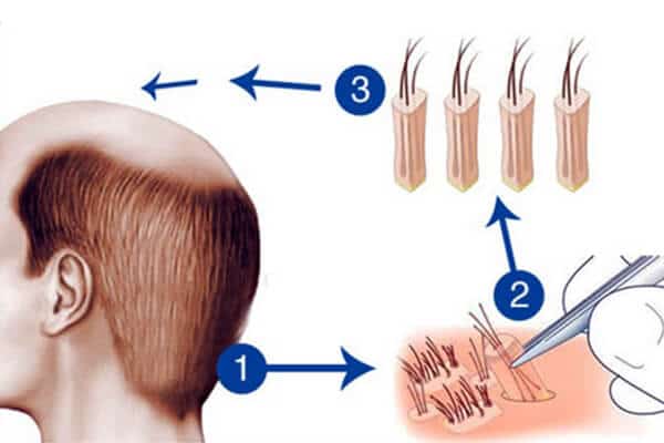 Cấy tóc là phương pháp trị rụng tóc hiệu quả