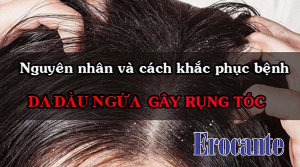 Da đầu ngứa gây rụng tóc