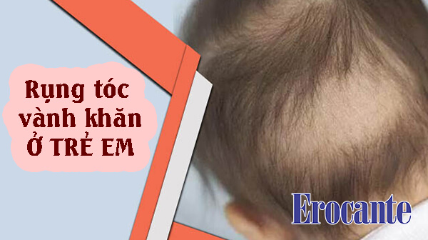 Rụng tóc vành khăn ở trẻ em