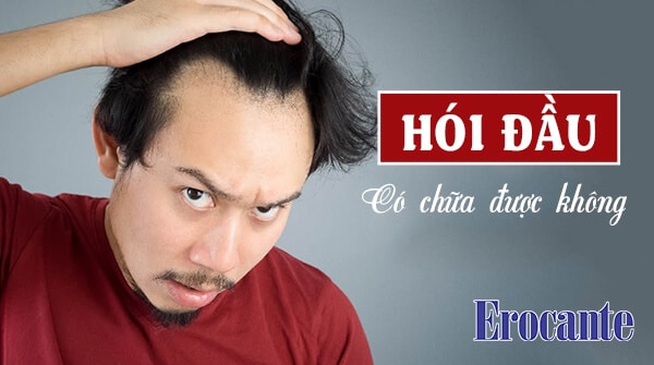 Hói đầu có chữa được không