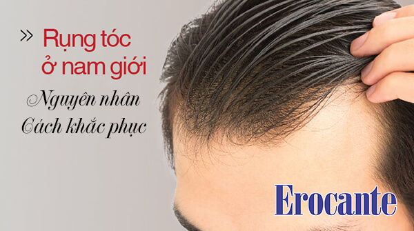 Rụng tóc nhiều ở nam giới Dấu hiệu bệnh tật không thể chủ quan