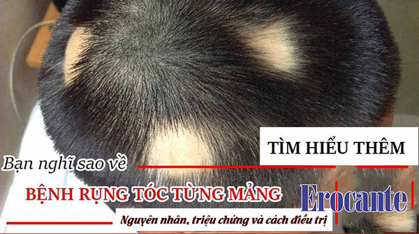 Rụng tóc từng mảng