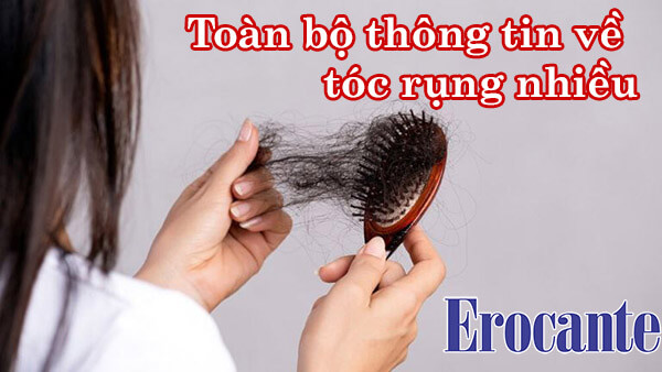 Tổng hợp toàn bộ thông tin về chứng tóc rụng nhiều