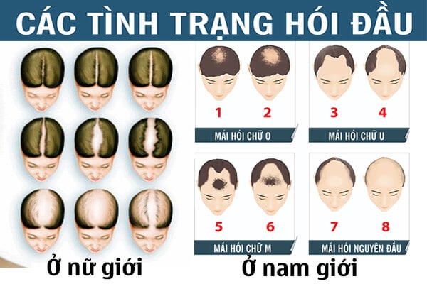 Các kiểu hói đầu phổ biến thường thấy ở nam giới và nữ giới