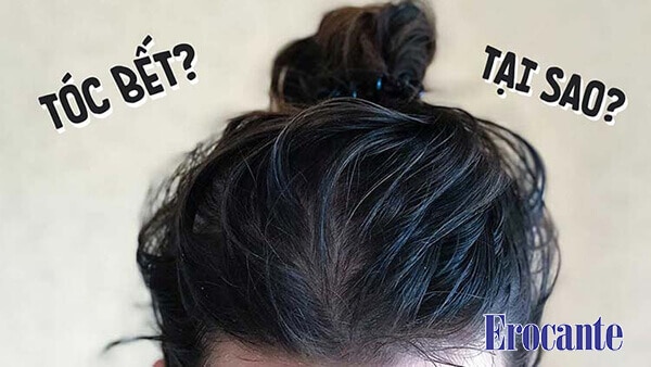 Lý do tóc nhanh bết và ngứa