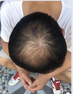 Chú Hùng bị rụng tóc trong nhiều năm